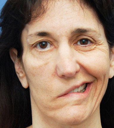 BELL'S AND FACIAL PALSY